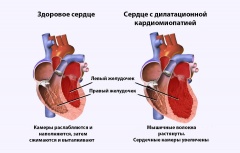 Что такое кардиомиопатия и какие существуют виды?